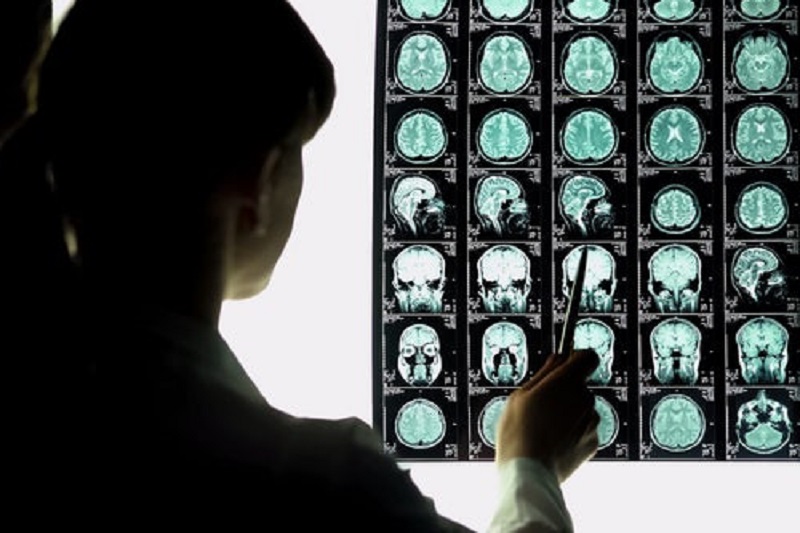 تشخیص سریع آلزایمر با بررسی گردش خونی مغز