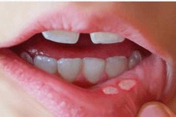 زخم هایی که ابتلا به سرطان دهان را افزایش می دهند